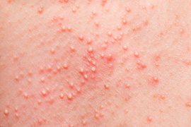 What’s Behind those Bumps and Rashes?